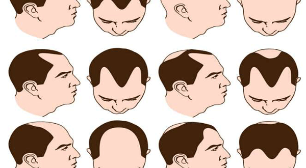 What Every Man Ought To Know About Treatment For Alopecia Areata - What Do
